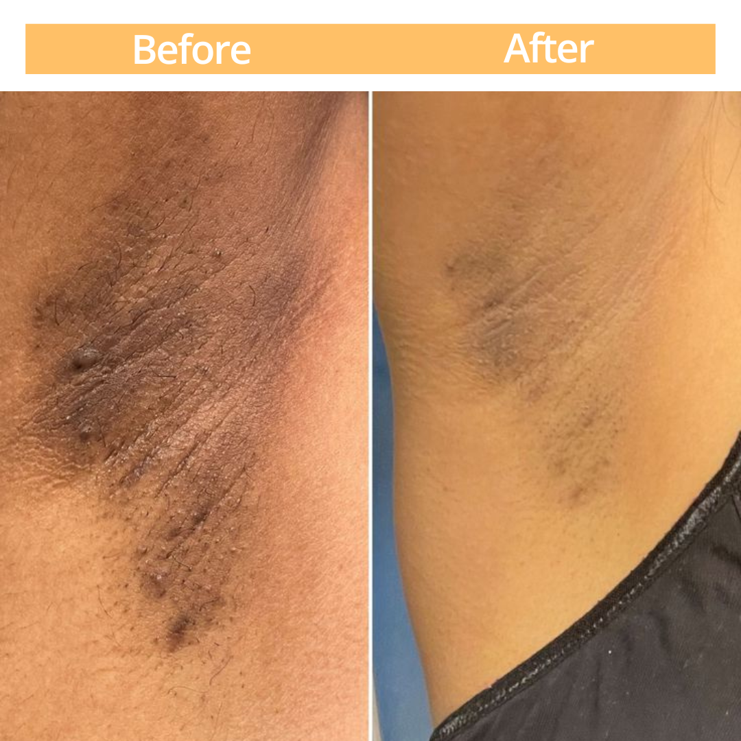 Gel Peeling SCULPT TOUCH - Elimina las manchas oscuras en piernas y axilas