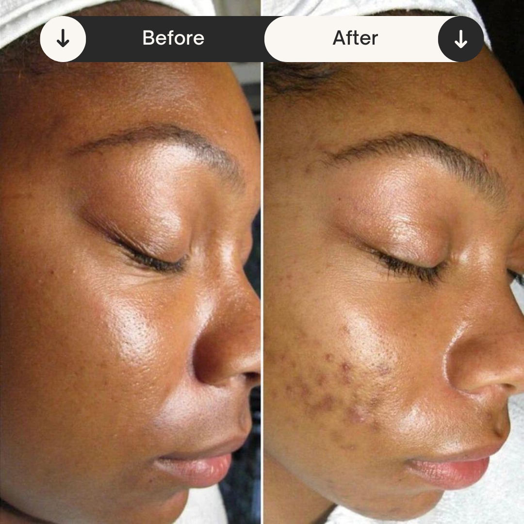 Discos de algodón con cúrcuma y tretinoína para el acné