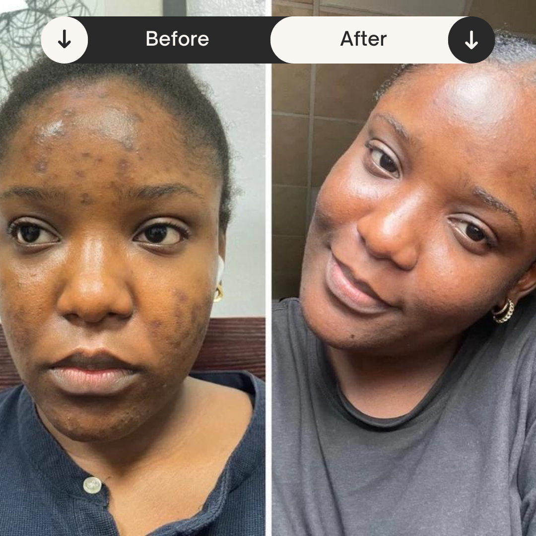 Discos de algodón con cúrcuma y tretinoína para el acné