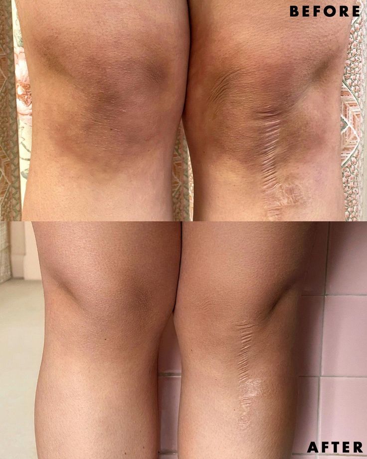 Gel Peeling SCULPT TOUCH - Elimina las manchas oscuras en piernas y axilas