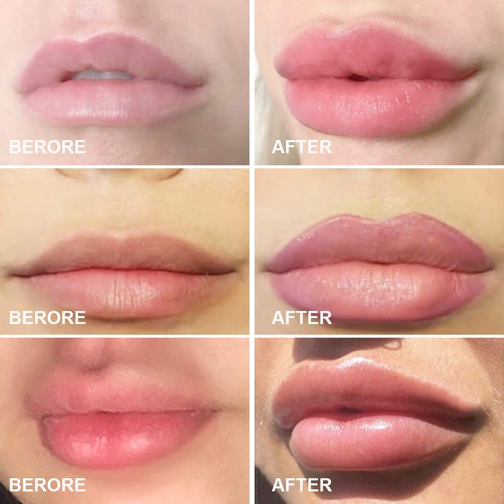 Lips Enhancer Device